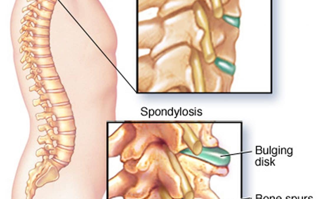 durere acută la nivelul coloanei vertebrale toracice