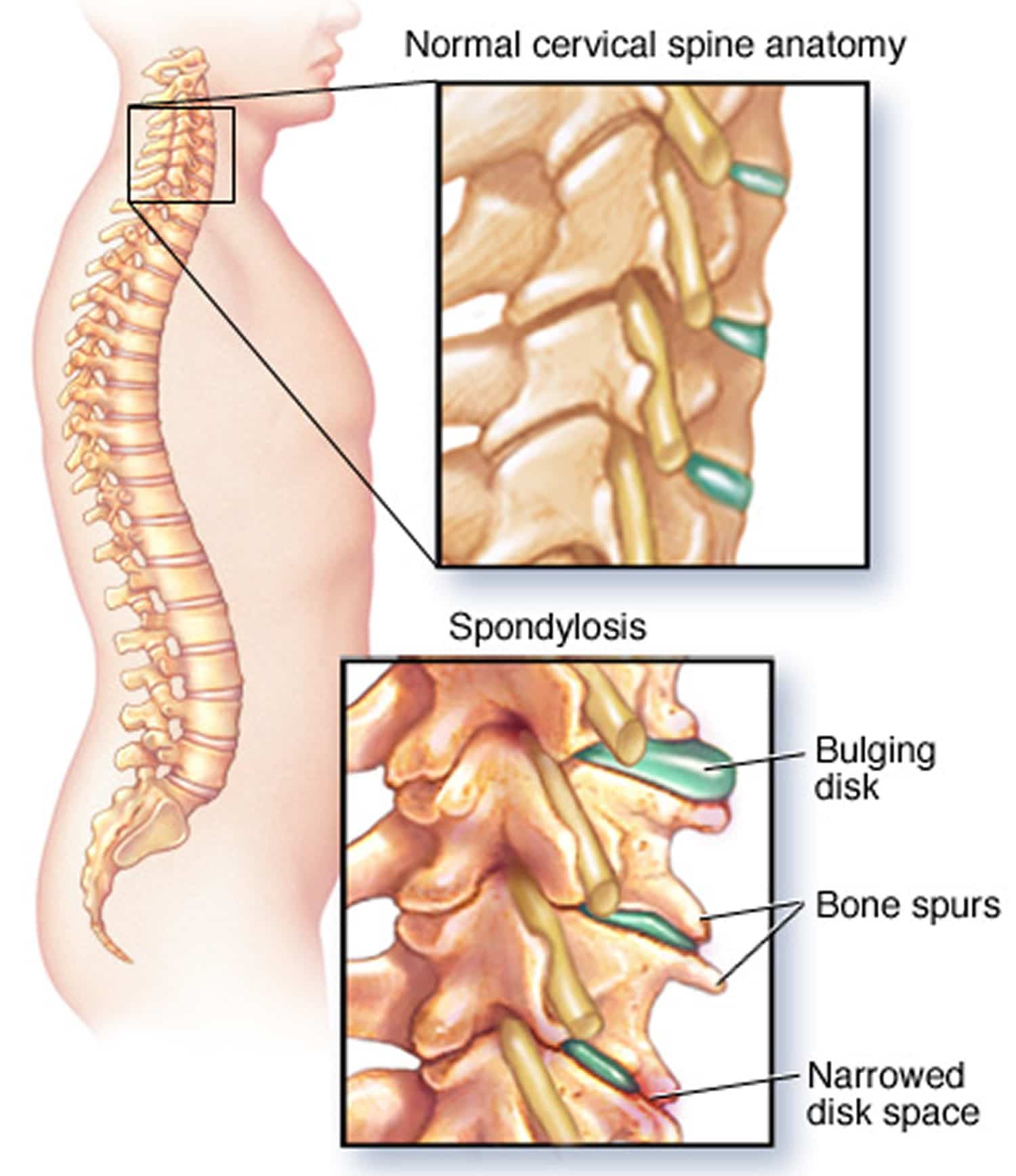 coloana cervicală și dorsală tratamentul artrozei de șold grad 2
