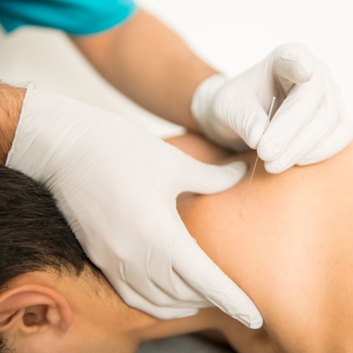 Sedinta Terapia Dry Needling Centrul Rafael -Recuperare Medicala Brasov